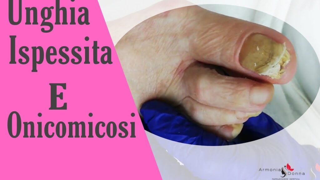 Unghia ispessita e onicomicosi