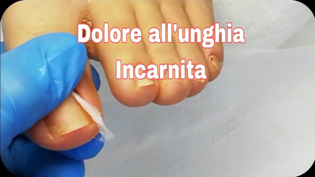 Unghia incarnita dolorosa, come applicare il cotone
