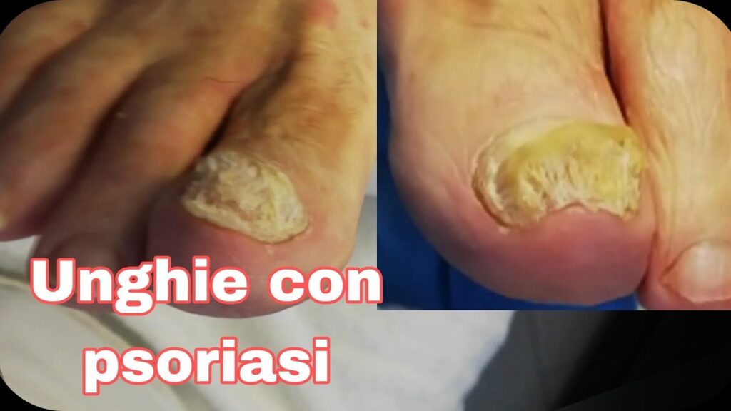 Trasformazione unghie con psoriasi : Cura e Autostima