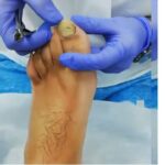 Alluce con micosi trattato con ipoclorito metodo Ruffini