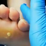 Calli sotto la pianta del piede: non vanno sottovalutati