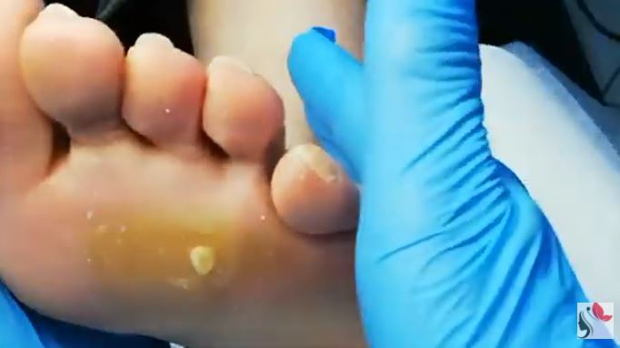 Calli sotto la pianta del piede: non vanno sottovalutati