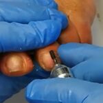 Come rimuovere calli e duroni con il micromotore