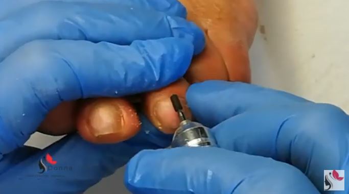 Come rimuovere calli e duroni con il micromotore
