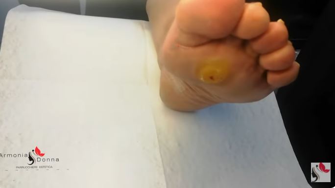 Calli e duroni dei piedi e l’impatto sulla postura