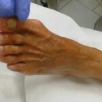 Pedicure unghie ispessite: problema comune in estetica