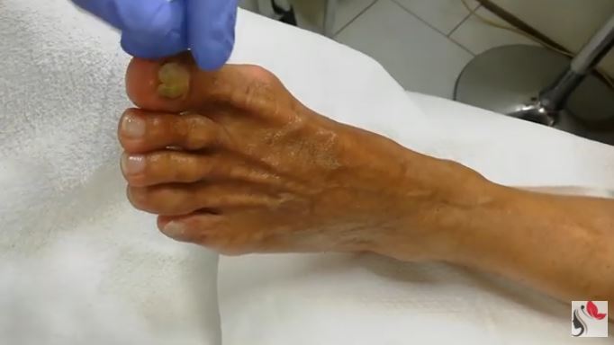 Pedicure unghie ispessite: problema comune in estetica