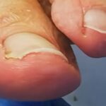 Trattare infezione unghia piede incarnita e dolorosa