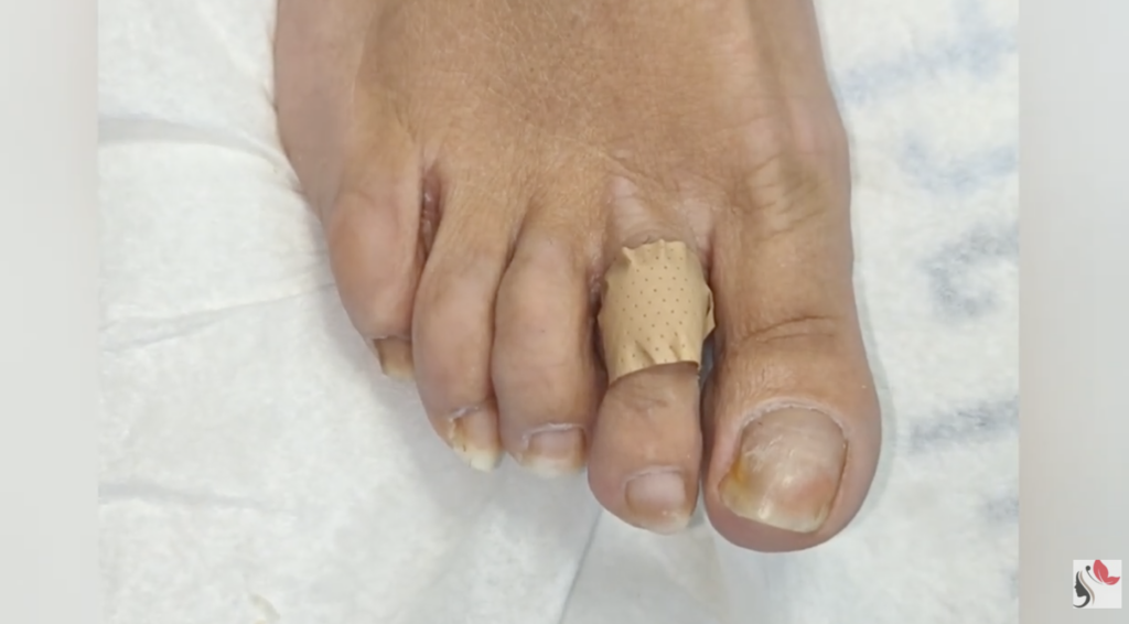 Unghia dell’Alluce con Onicolisi: Dito a Martello e Callo
