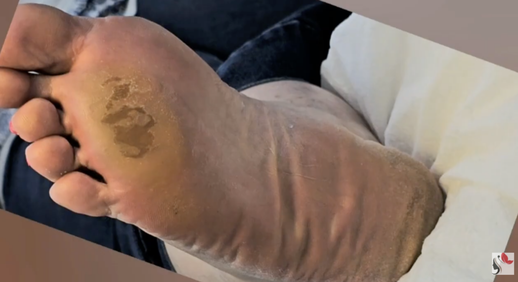 Perché si formano i calli sotto la pianta del piede