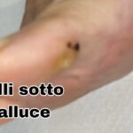 Calli sotto alluce: trattamento professionale e cura piede