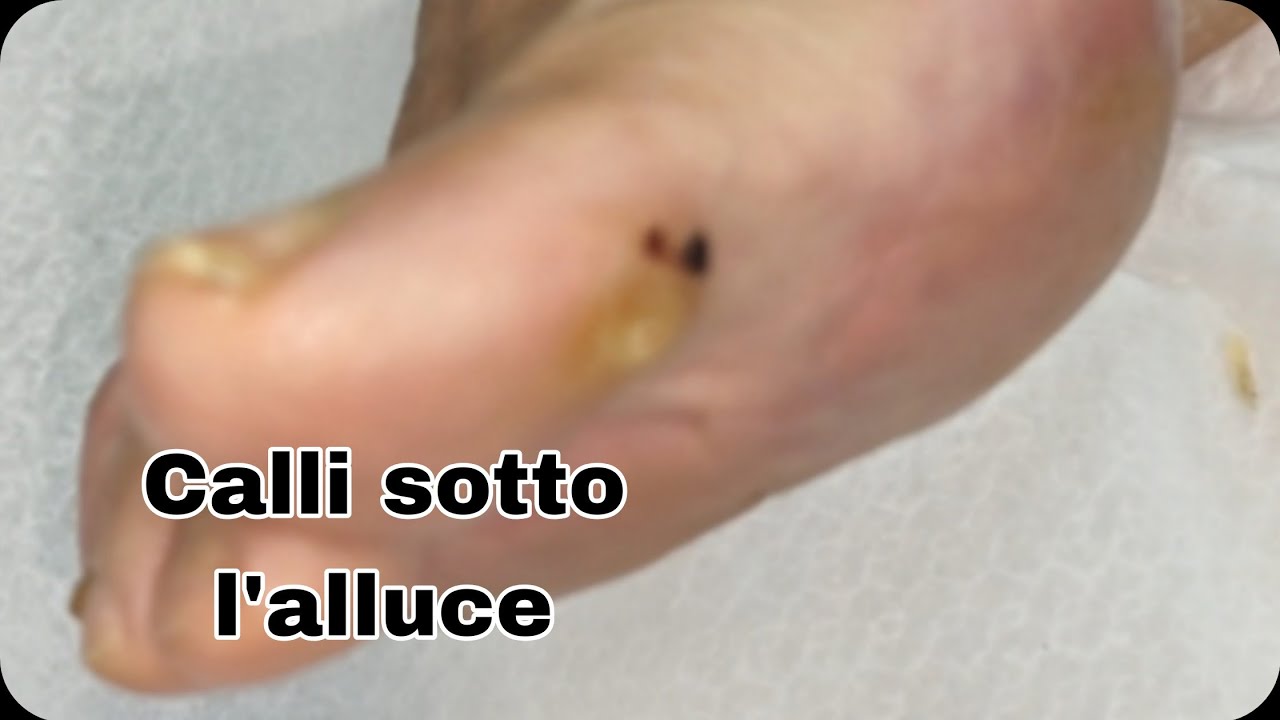Calli sotto alluce: trattamento professionale e cura piede