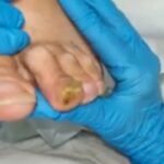 Calli sulle dita del piede: eliminare dolore e ispessimenti