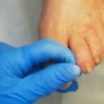 Unghie ispessite involute: Pedicure Estetico Specialistico
