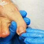 Trattare le unghie degli alluci: tecnica professionale