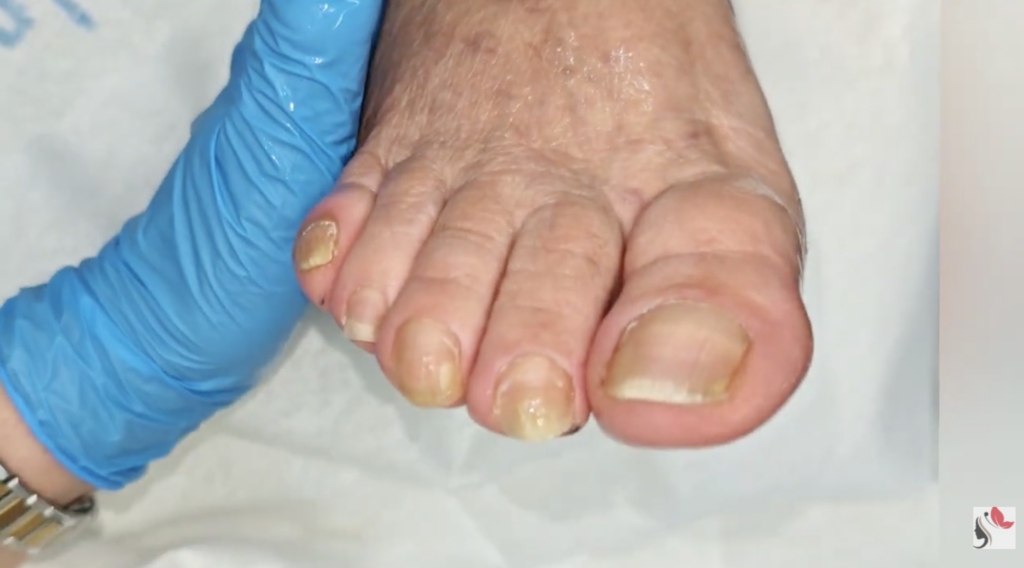 Pedicure Onicolisi sull’Alluce e sul Secondo Dito
