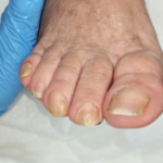 Pedicure Onicolisi sull’Alluce e sul Secondo Dito