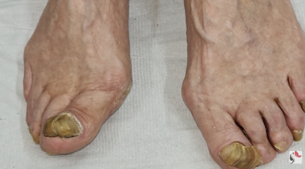Piedi trascurati e segnali da non ignorare