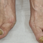 Piedi trascurati e segnali da non ignorare