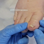 Unghia dell’Alluce Involuta: Cause e Trattamento