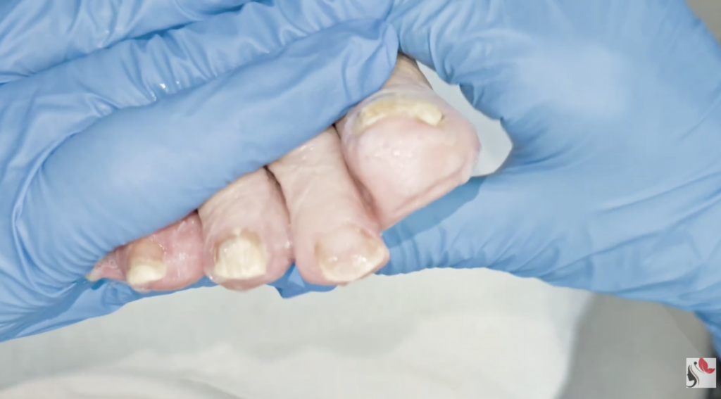 Pedicure professionale per unghie con psoriasi